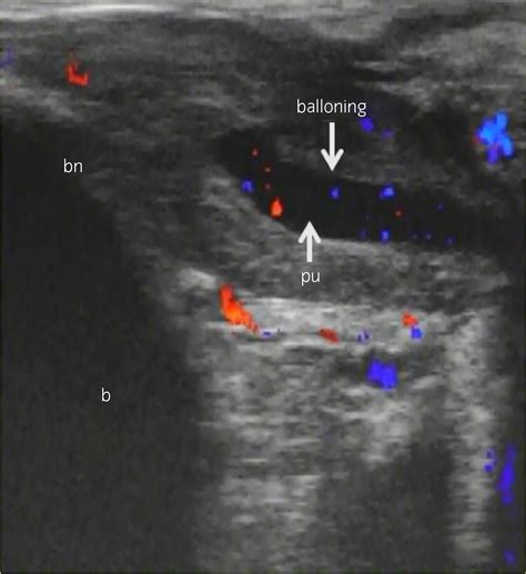 Male squirting: Analysis of one case using color Doppler ...